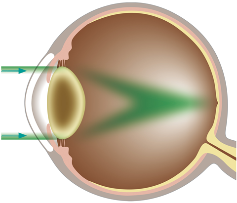 画像 白濁した水晶体