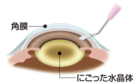 角膜切開｜三軒茶屋はるやま眼科