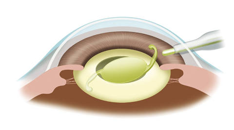 眼内レンズ挿入｜三軒茶屋はるやま眼科