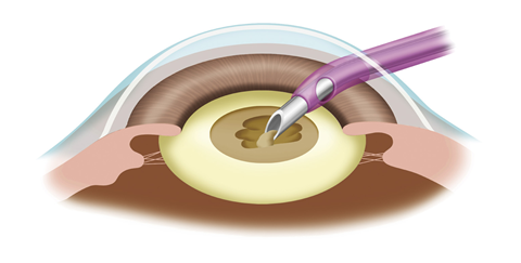 水晶体の核処理｜三軒茶屋はるやま眼科